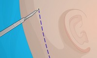 Chirurgie de l'oreille